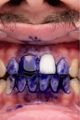 Blanqueador Dental Obsessive | Sonrisa radiante ✨