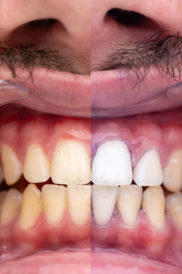 Blanqueador Dental Obsessive | Sonrisa radiante ✨